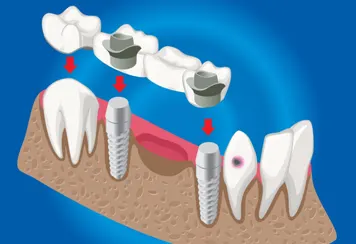 Crowns-and-Bridges Crowns and bridges at UV Dental
