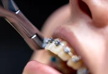 Orthodontics Orthodontics at UV Dental