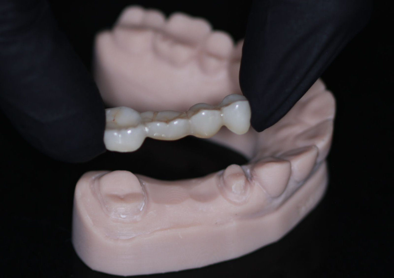 Crowns and bridges at UV Dental